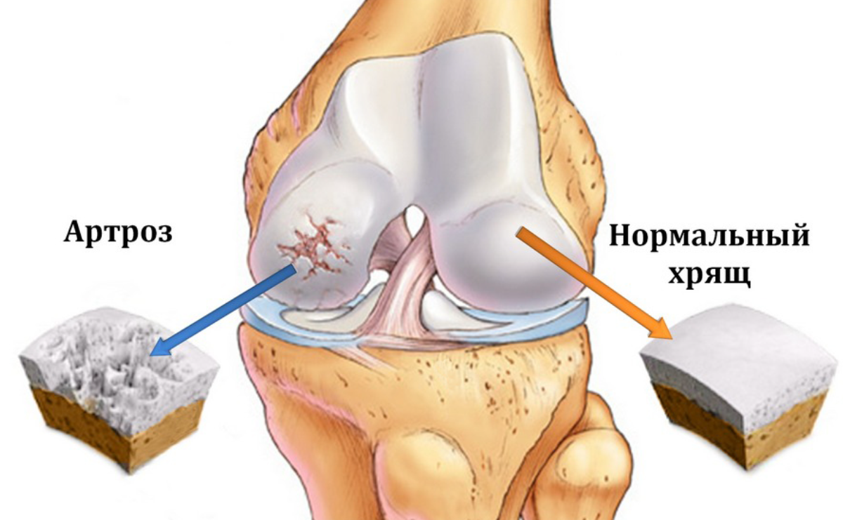 Артроз коленного сустава (гонартроз)